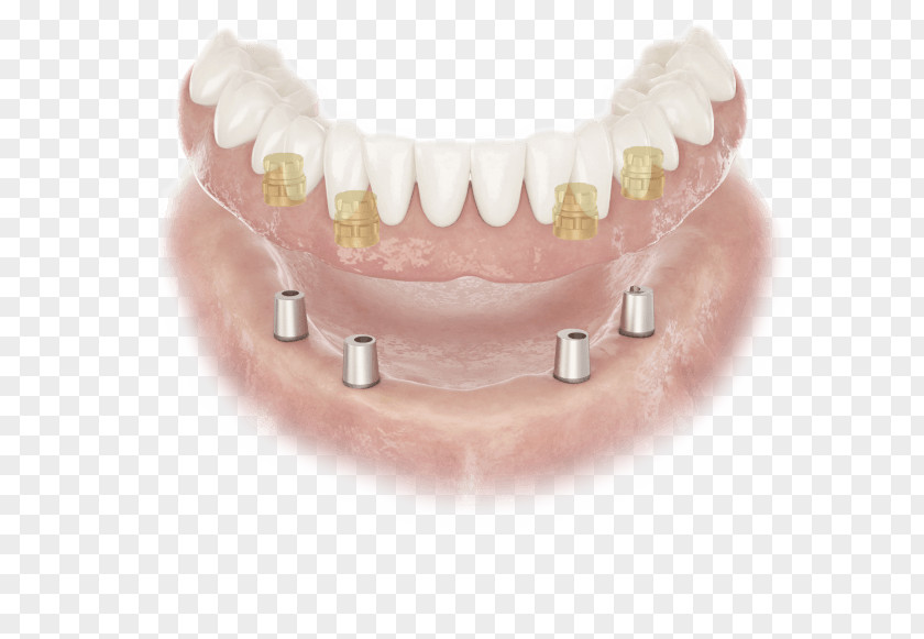 Abutment Dentures Dental Implant Dentist Edentulism PNG