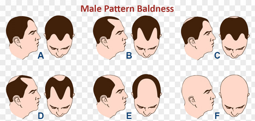 Hair Coloring Pattern Loss Pubic PNG