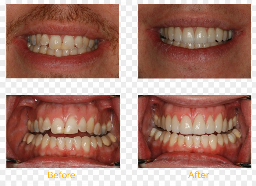 Bridge Tooth Whitening Cosmetic Dentistry Veneer PNG