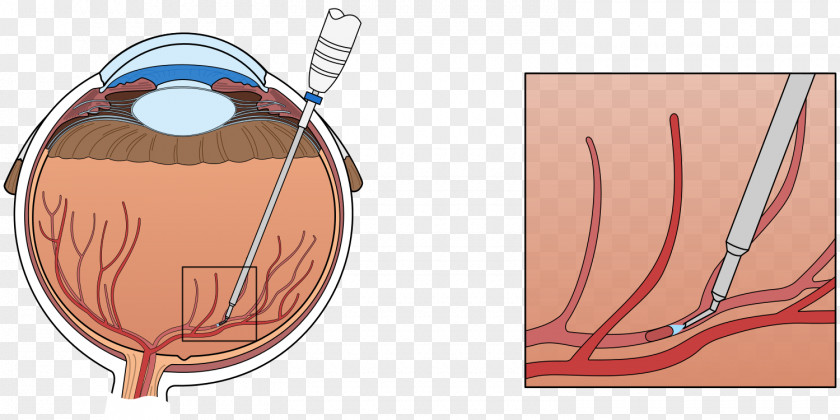 Anatomy Central Retinal Vein Occlusion Vascular PNG