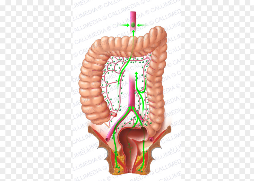 Digestive System Colorectal Cancer Lymph Node Rectum PNG