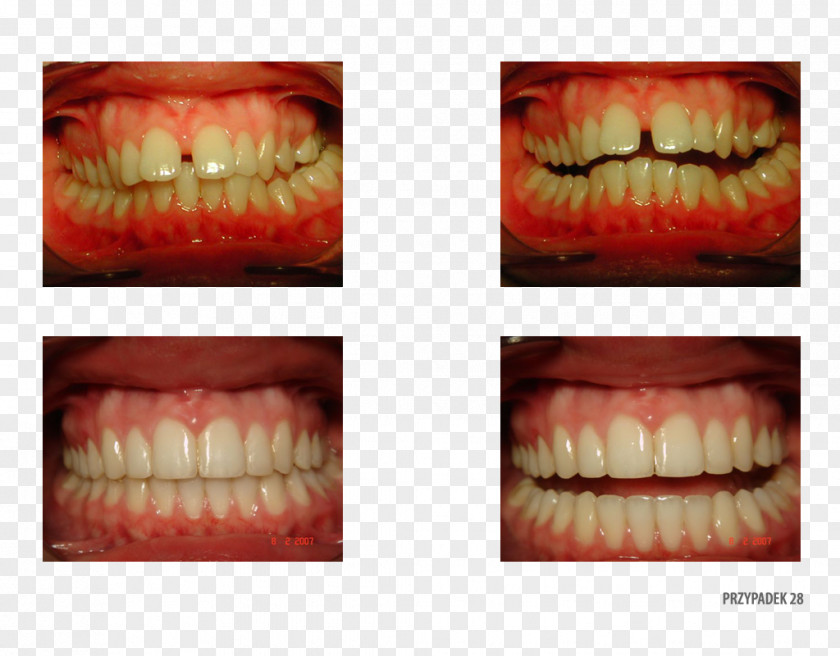 Orange Polska Tooth Close-up Therapy PNG