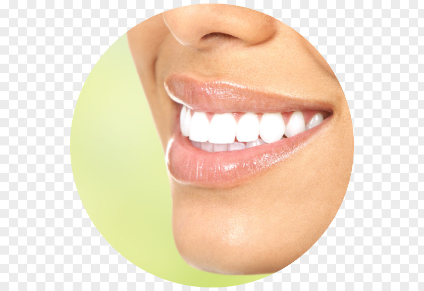 Veneers Tooth Whitening Cosmetic Dentistry PNG