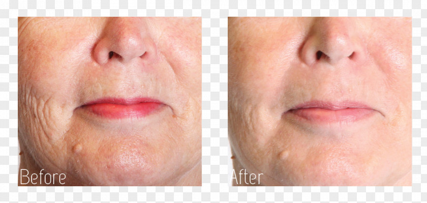 Face Collagen Induction Therapy Wrinkle Rhytidectomy PNG