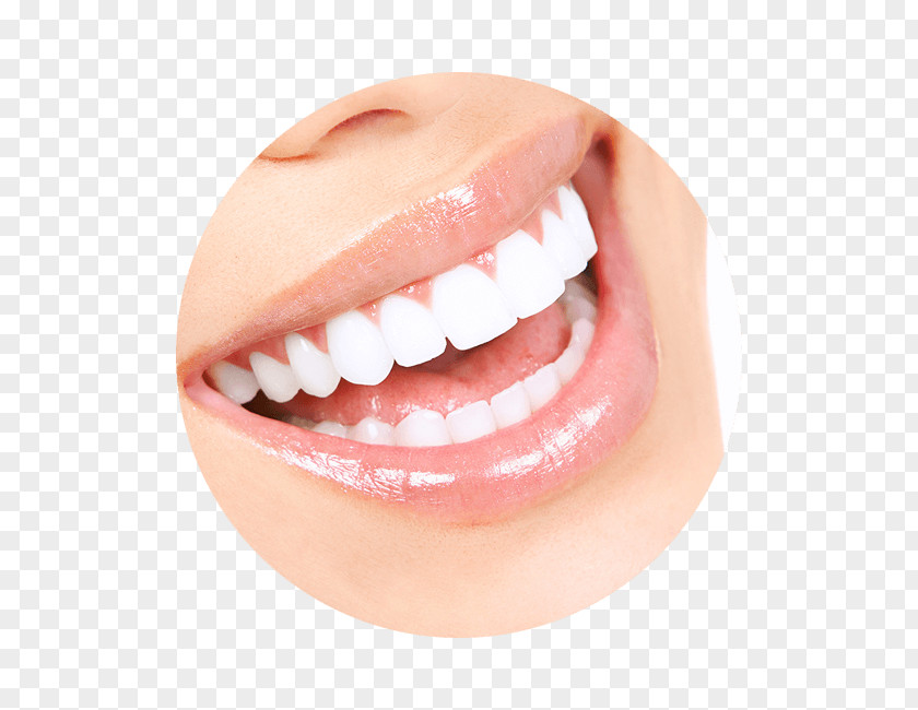 Cosmetic Dentistry Tooth Whitening Human Veneer PNG