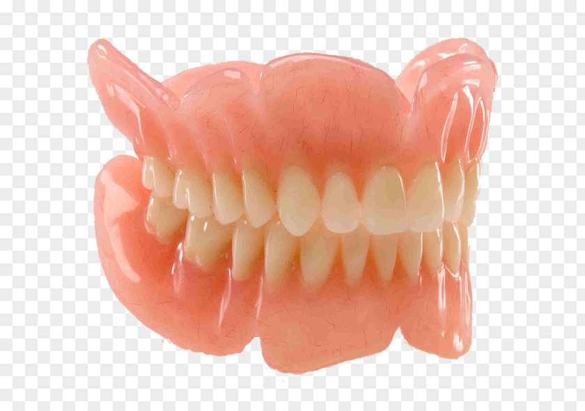Bridge Dentures Dentistry Removable Partial Denture Prosthesis Dental Implant PNG