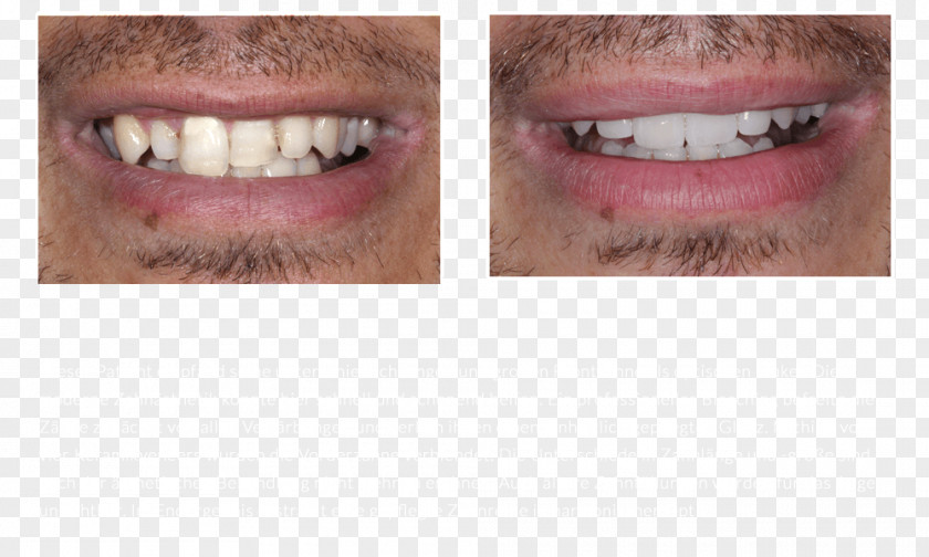 Bridge Tooth Whitening Veneer DiPura PNG