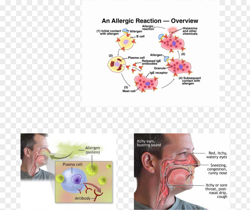 Allergy Type I Hypersensitivity Disease Health PNG