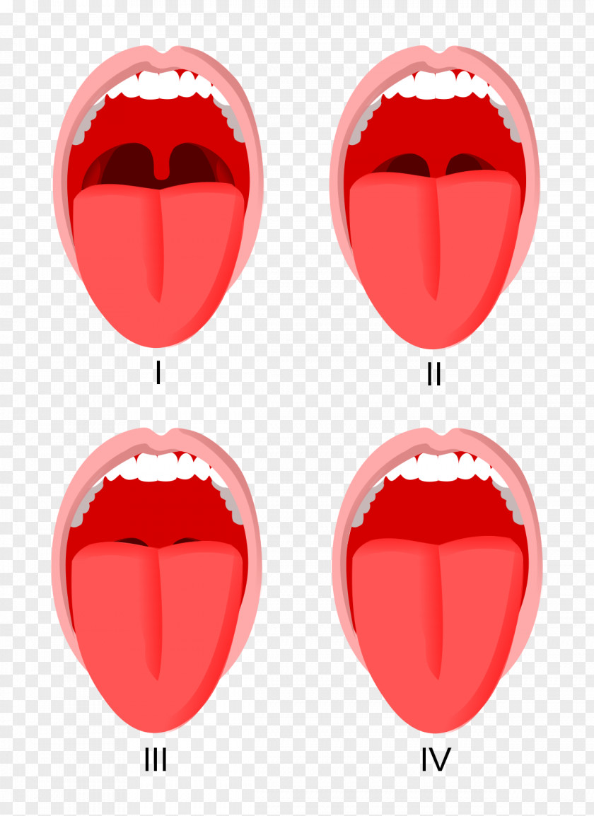 Mallampati Score Tracheal Intubation Anesthesia Simplified Airway Risk Index Sleep Apnea PNG