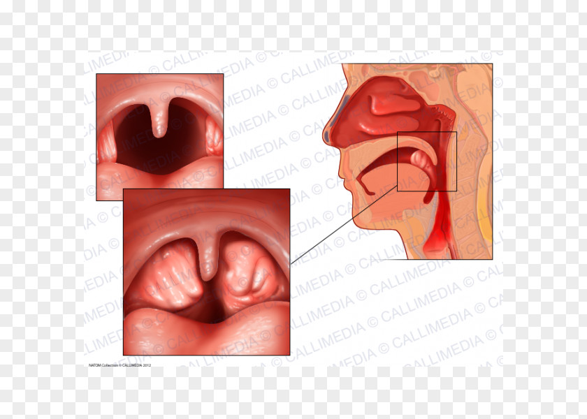 Tonsil Tonsillitis Anatomy Adenoid Infection PNG
