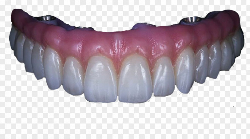 Crown Human Tooth Angelet De Les Dents Dentures Dental Implant PNG