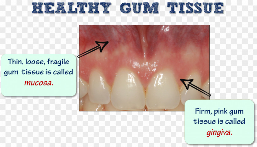 Tooth Periodontal Disease Gums Edentulism Dental Plaque PNG
