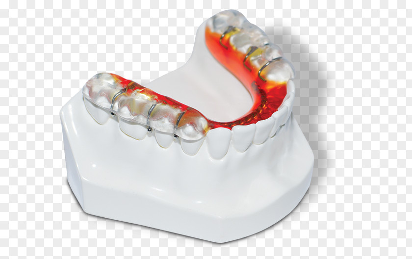 Mandibular Advancement Splints Mandible Jaw Tooth Maxilla Dentistry PNG