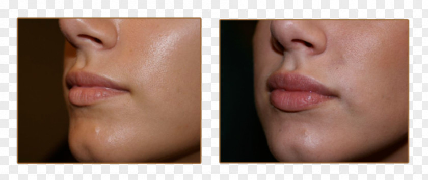 Lip Augmentation Injectable Filler Juvéderm Cheek PNG