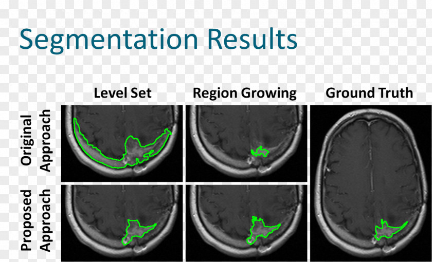 Segmentation Image Brain Tumor Magnetic Resonance Imaging Analysis Region Growing PNG