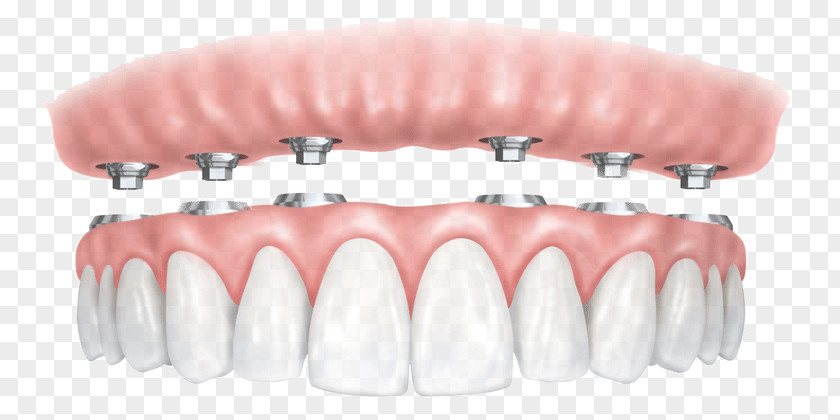 All-on-4 Dental Implant Dentures Dentistry PNG