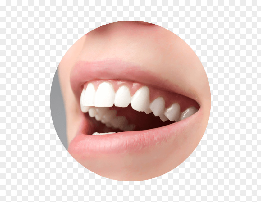 Crown Ceramic Tooth Veneer Dentistry PNG