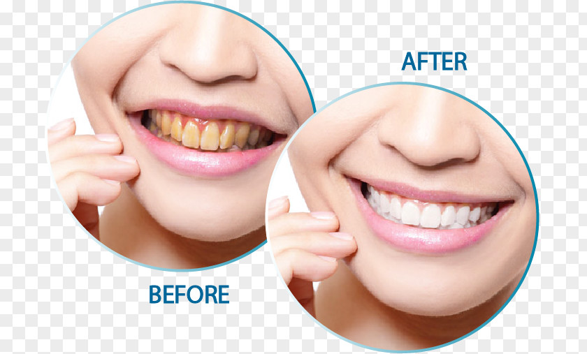 Teeth Smile Cosmetic Dentistry Tooth Endodontics PNG