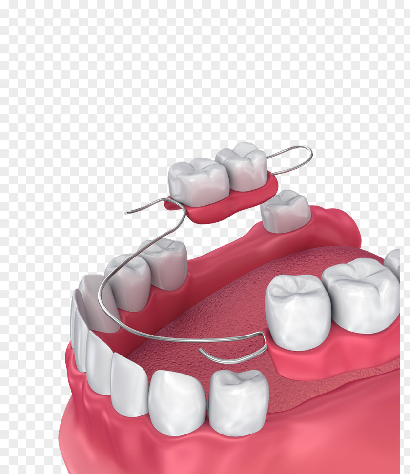 Bridge Removable Partial Denture Dentures Dentistry Tooth PNG