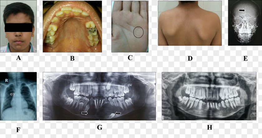 Physical Examination Nevoid Basal-cell Carcinoma Syndrome Jaw Keratocystic Odontogenic Tumour Prognathism PNG