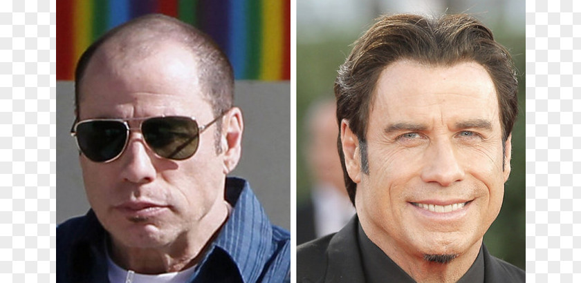 John Travolta Cleese Hair Transplantation Loss Celebrity PNG