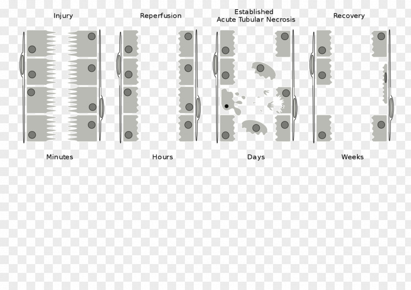 Kidney Acute Failure Tubular Necrosis Disease PNG