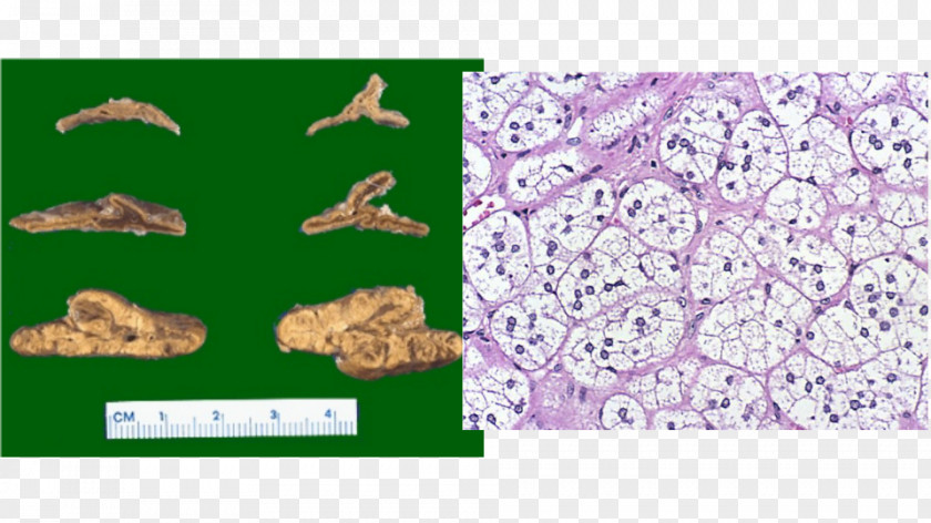 Thyroid Nodule Adrenal Gland Hyperplasia PNG