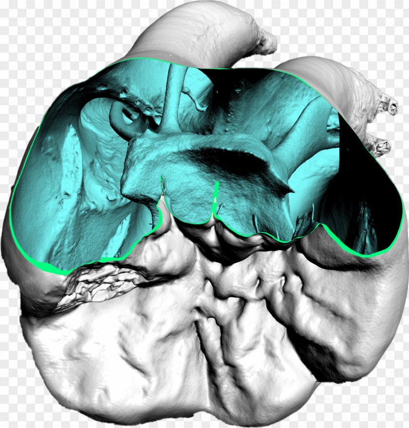 X-ray Dentistry Computed Tomography Dental Impression PNG