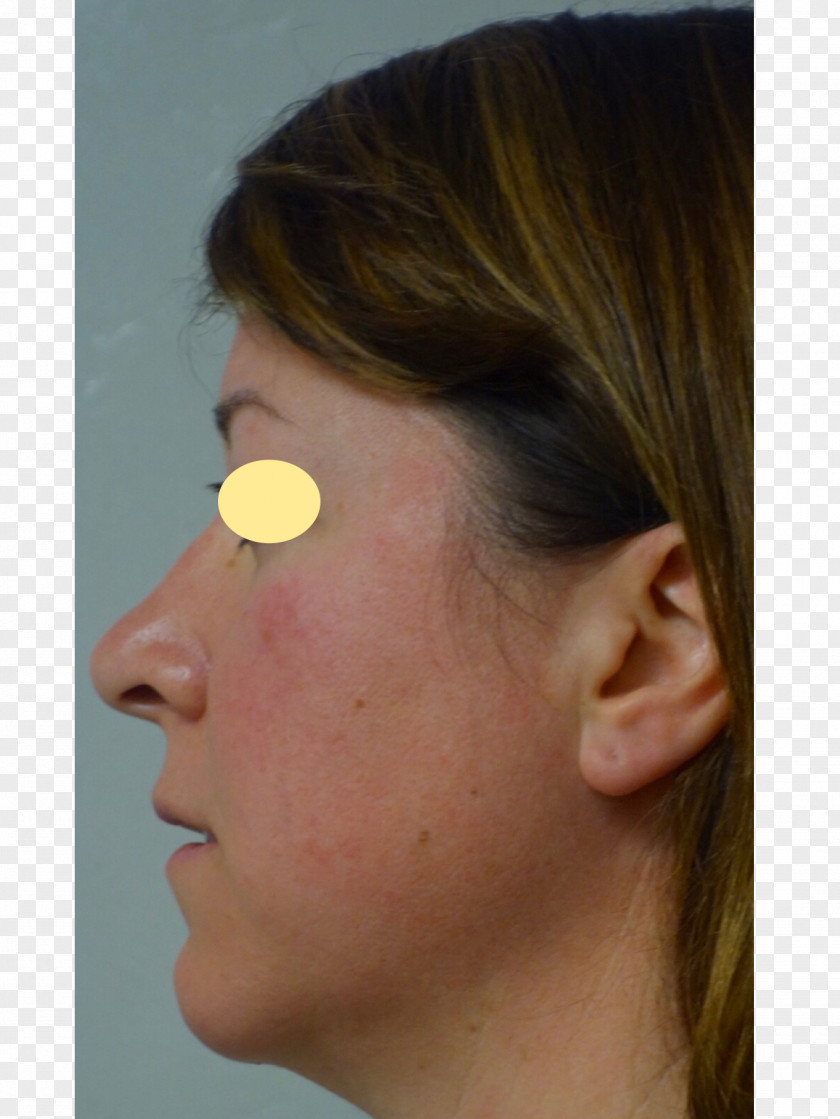 Buccal Fat Removal Nose Cheek Chin Forehead Eyebrow PNG