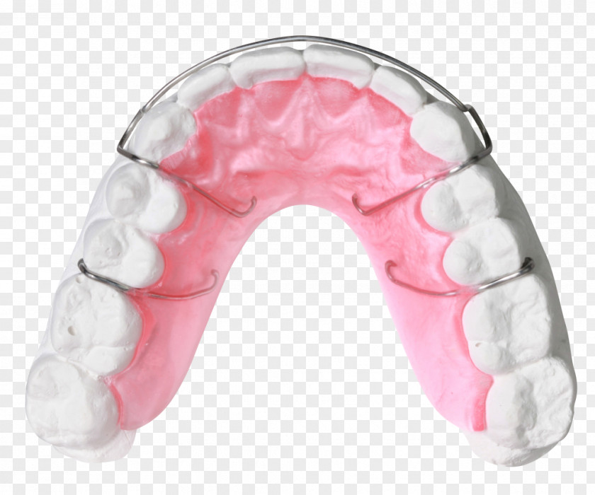 Orthodontics Orthodontic Technology Jaw Quad Helix Dentistry PNG