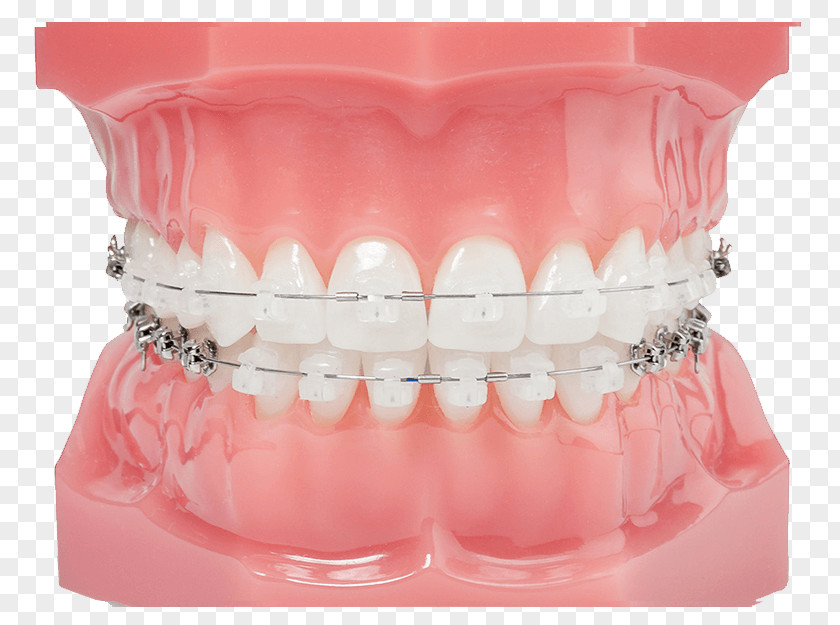 Aparat Damon System Clear Aligners Dental Braces Orthodontics Dentistry PNG