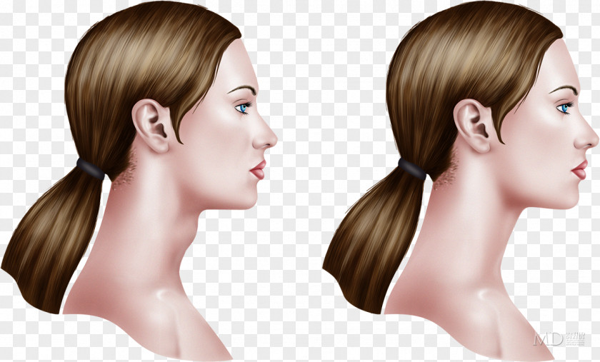 Face Mentoplasty Chin Masseter Muscle Buccal Fat Pad PNG