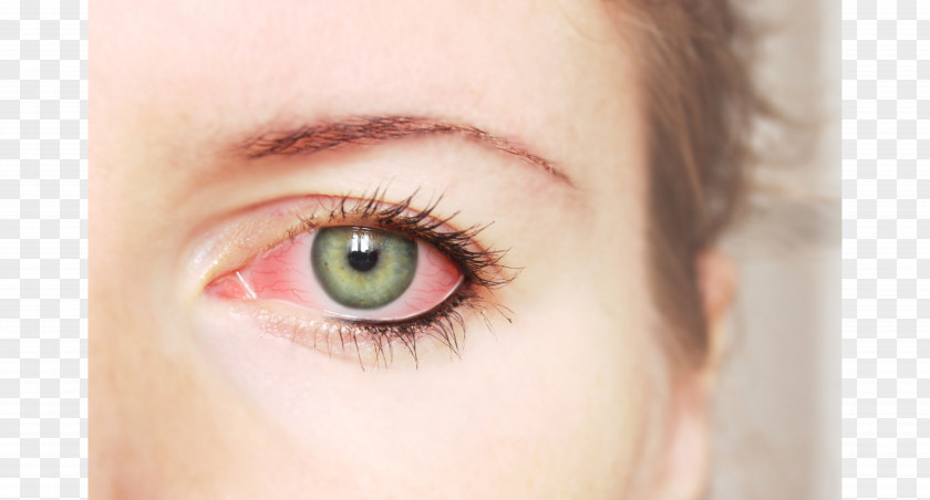 EYE CARE Eyelid Conjunctivitis Rheum Irritation PNG
