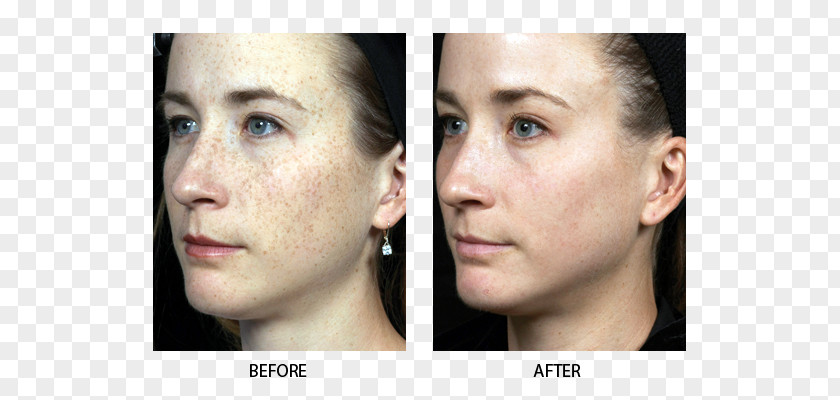 Laser Skin Fraxel Photorejuvenation Dermatology Hair Removal PNG