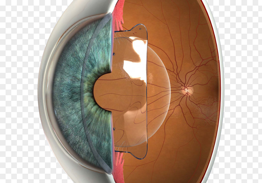 Eye Phakic Intraocular Lens Implantable Collamer LASIK Visual Perception PNG