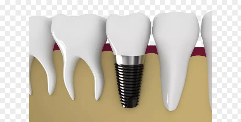 White Teeth Material Dental Implant Dentistry Tooth Veneer Restoration PNG