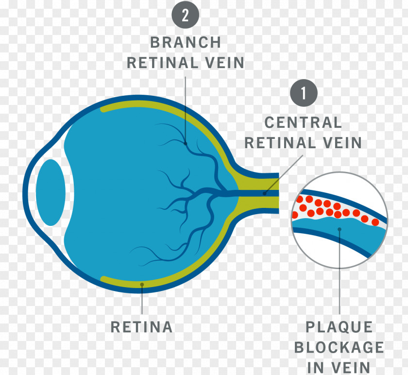 Rheumatology Graphic Flash Blindness Central Retinal Vein Occlusion Eye Logo PNG