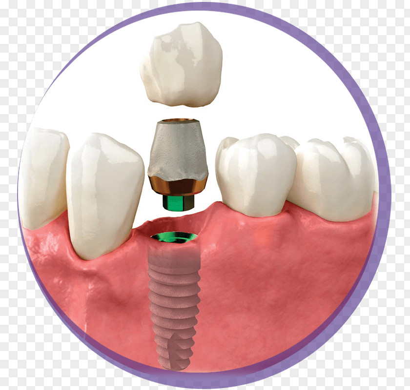 Implant Tooth Dental Crown Zimmer Biomet PNG