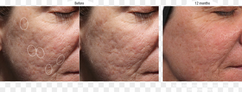 Acne Scars Scar Injectable Filler Wrinkle Artefill PNG
