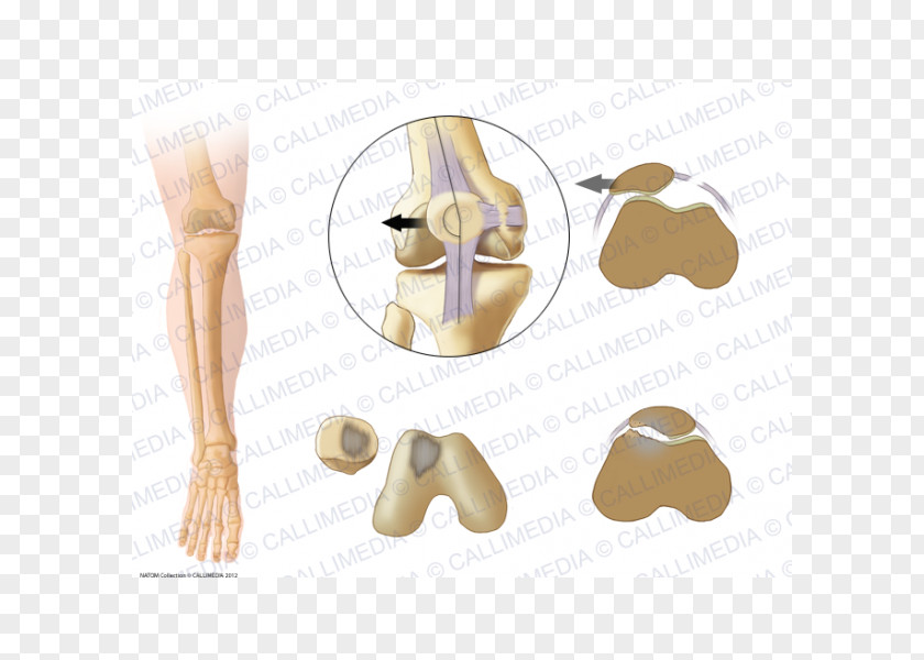 360 Degrees Shoulder Patella Bone Subluxation Joint Dislocation PNG
