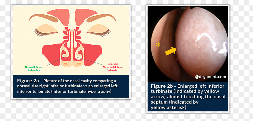 Nose Nasal Concha Otorhinolaryngology Sinus Septoplasty PNG