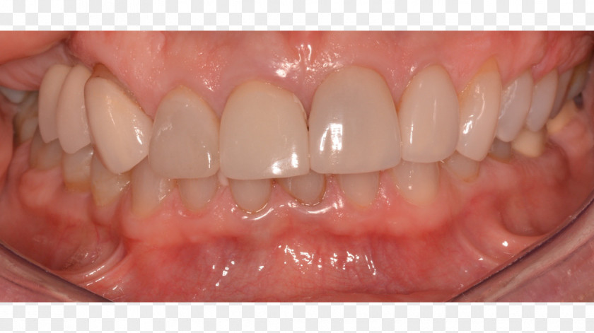 Human Tooth Cosmetic Dentistry Veneer PNG