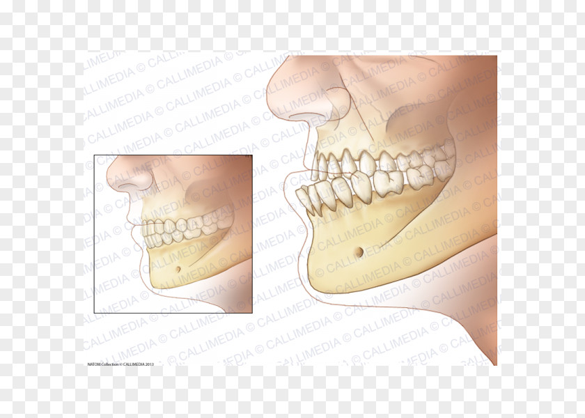 Prognathism Acromegaly Jaw Endocrinology Growth Hormone PNG