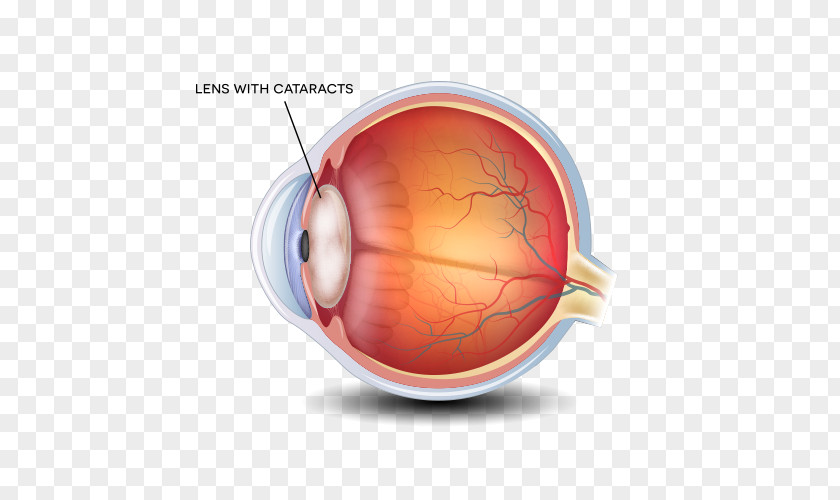Eye Cataract Surgery Ophthalmology Lens Care Professional PNG