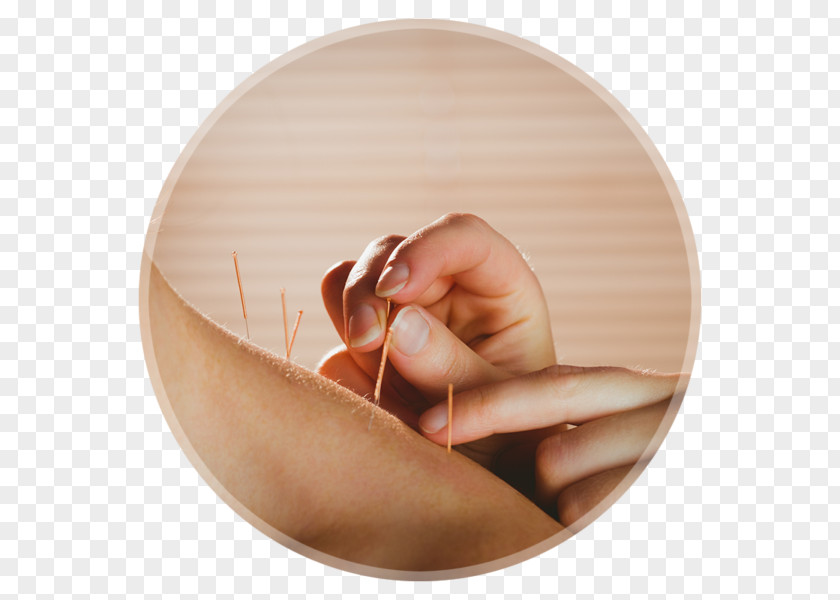 Sunshine Coast Acupuncture Clinic Wit Dry Needling Myofascial Trigger Point Myotherapy Release PNG