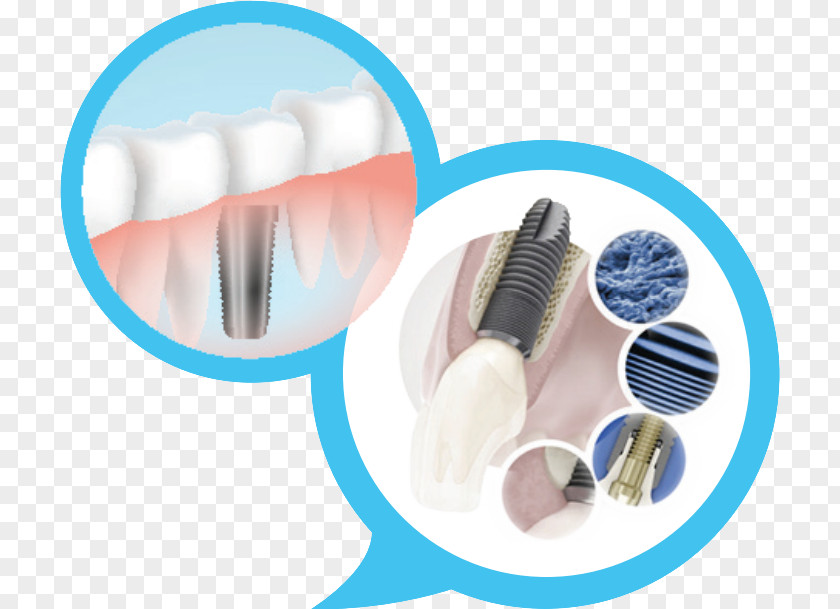 Dental Implants Implant Dentistry OSSTEM IMPLANT PNG