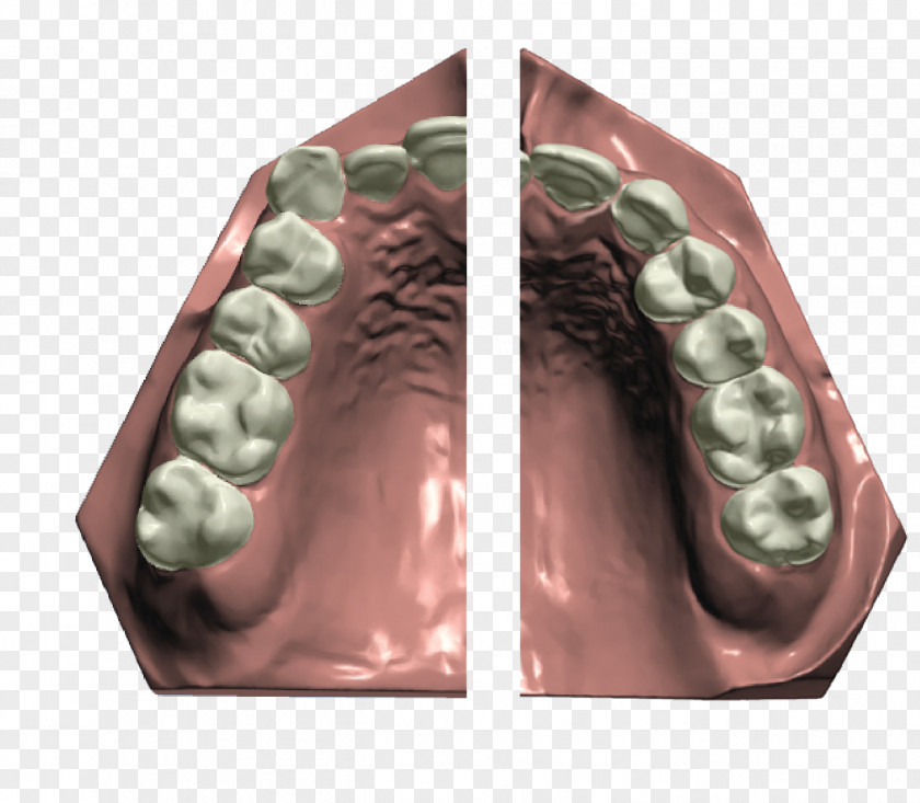 Orthodontics CAD/CAM Dentistry Dental Implant Braces PNG