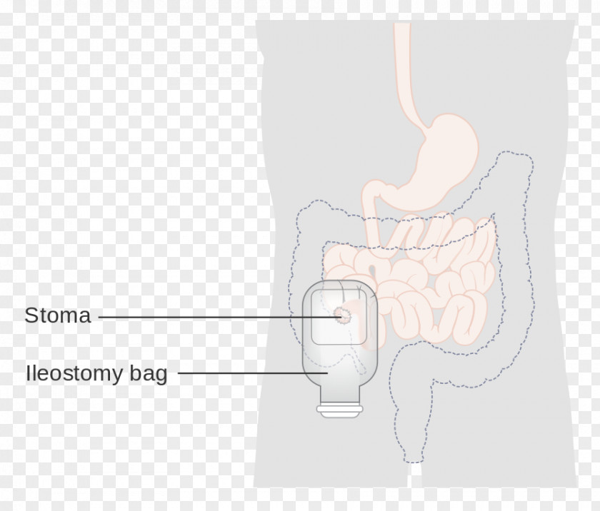 Ileostomy Abdomen Hip Shoulder Thumb PNG