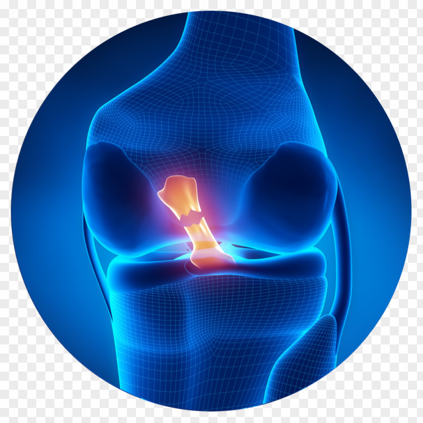 Ligament Anterior Cruciate Injury Medial Collateral Reconstruction PNG