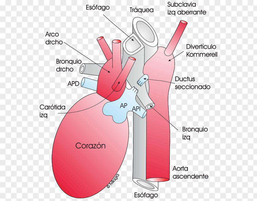 Heart Aberrant Subclavian Artery Aortic Arch Aorta Diverticolo Di Kommerell PNG